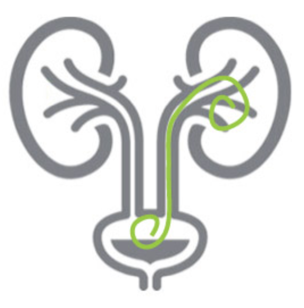 Jak wygląda cewnik DJ.