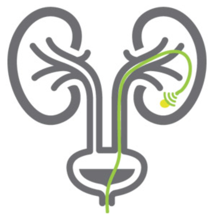 Zabieg RIRS – przełomowa metoda leczenia kamicy